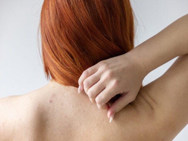 Body Acne